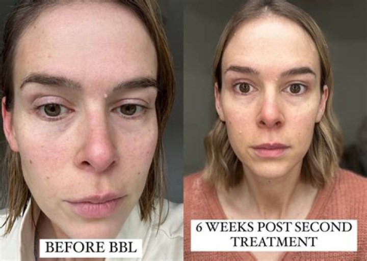 Danileigh Before And After Photos | Did She Have BBL